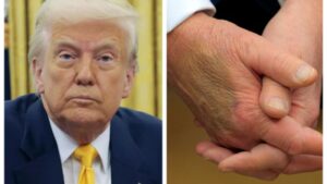 Is Trump taking Ozempic? Conspiracy theories swirl while mystery skin patch reappears on his hand