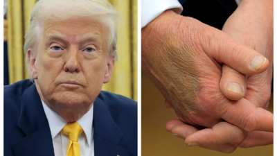 Is Trump taking Ozempic? Conspiracy theories swirl while mystery skin patch reappears on his hand Is Trump taking Ozempic? Conspiracy theories swirl while mystery skin patch reappears on his hand